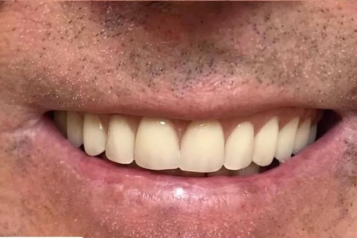 Depois do caso de Prótese dentária