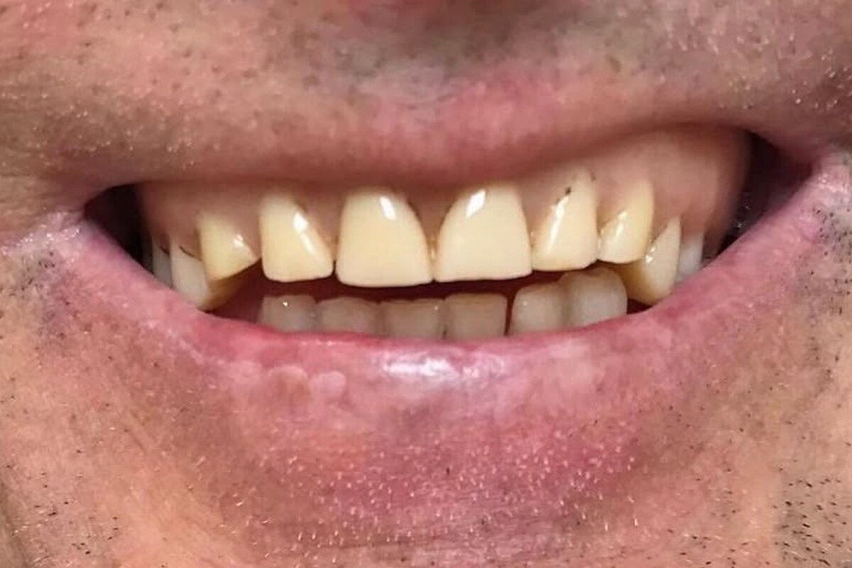 Antes do caso de Prótese dentária